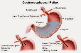 http://ayusri-rahayuu.blogspot.com/2013/12/cara-mengobati-penyakit-asam-lambung.html