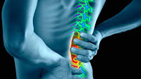 Epidural Administration - Cortisone Shot For Back Pain Side Effects