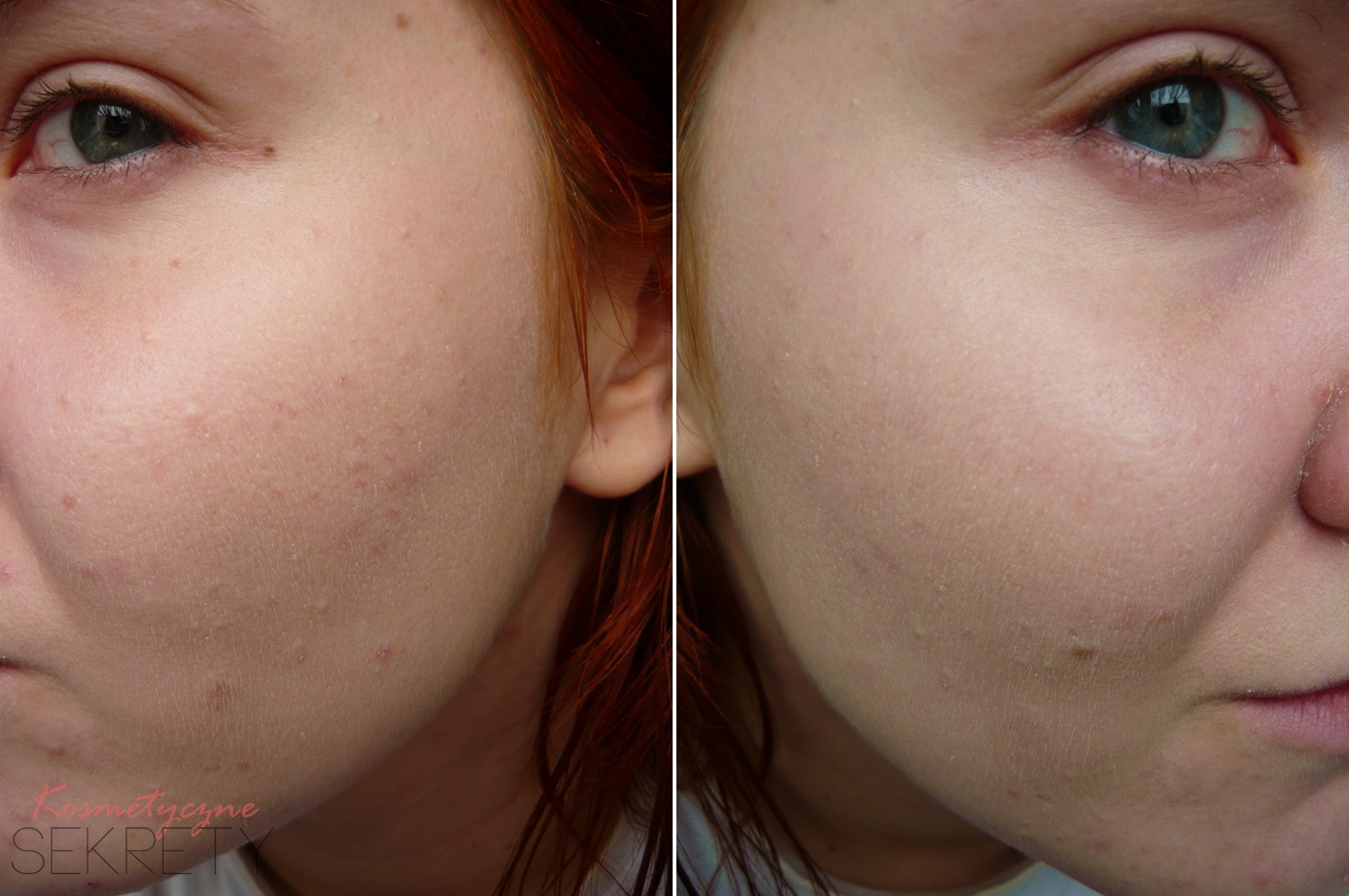 Kosmetyczne Sekrety Kuracja Acne Derm Efekty Po 6 Miesiacu Stosowania