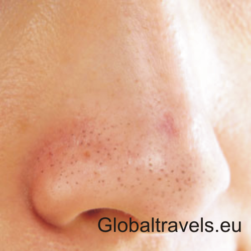 How To Remove Blackheads From Your Nose At Home | Apps Directories