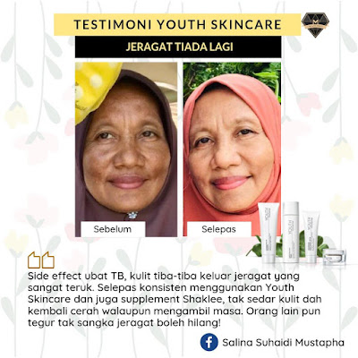 Testimoni-Youth-Skincare-Jeragat-Hilang