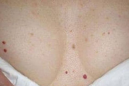 Do You Have These Red Spots On Various Parts Of Your Body!!!