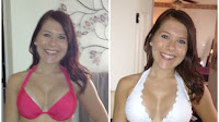 Teri Weigel - Breast Augmentation Palm Beach