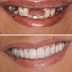 Mất 2 răng cửa nên làm cầu răng hay implant? 