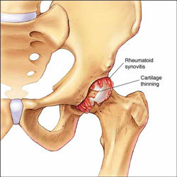 http://orthopaedic-surgery-india.com/hip-replacement/