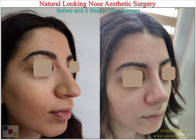 Natural rhinoplasty,Natural Nose Aesthetic Surgery,Natural Nose Job,Natural Looking Nose Operation,