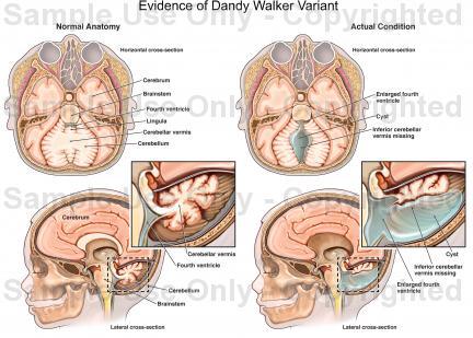 Dandy Walker Syndrom