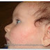 All About Dermatitis in Babies