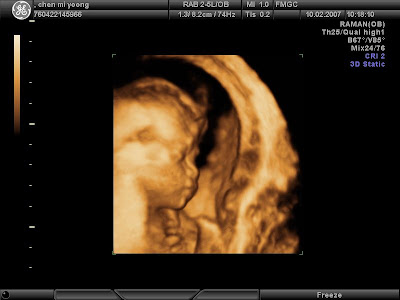 My First Grandson Scan with a recognizable face
