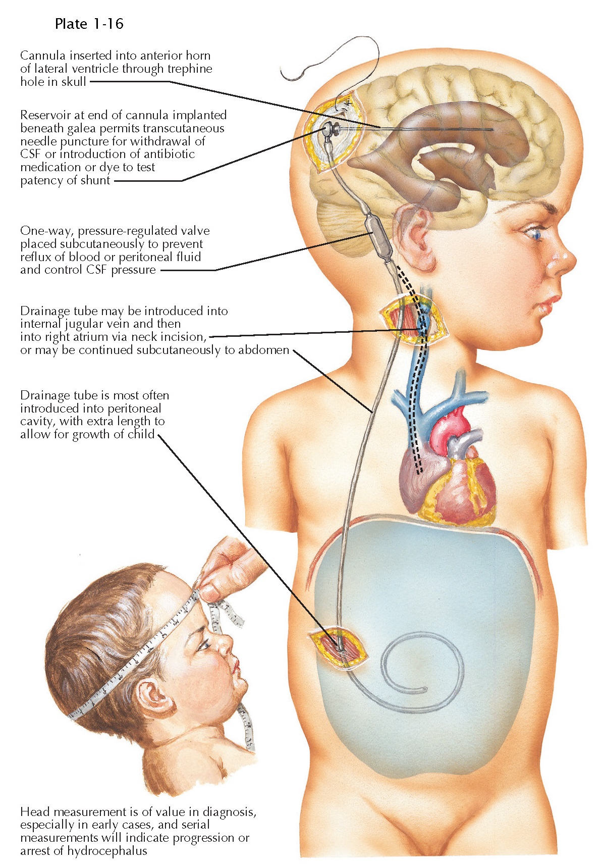 SURGICAL TREATMENT OF HYDROCEPHALUS