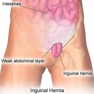 Cara Cepat Mengobati Penyakit Hernia