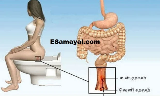 பைல்ஸ் பிரச்சனைக்கு முற்றுப்புள்ளி