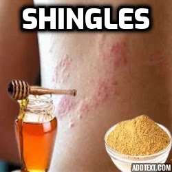 Shingles. 5 things to know to treat shingles effectively and safely