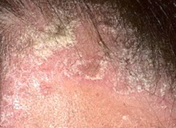 8 Penyakit Kulit Psoriasis Gejala Penyebab Cara  Mengatasi 