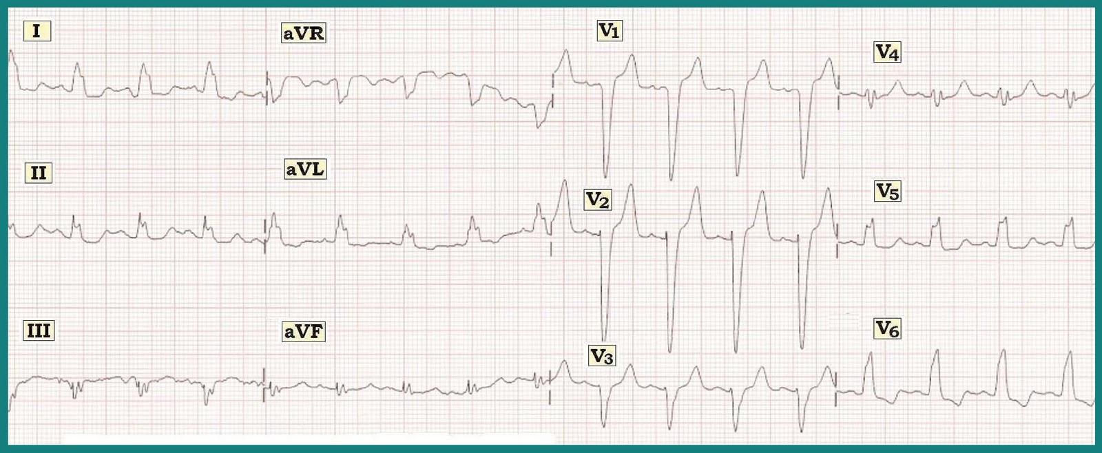 Figure 1 (ECG reproduced from