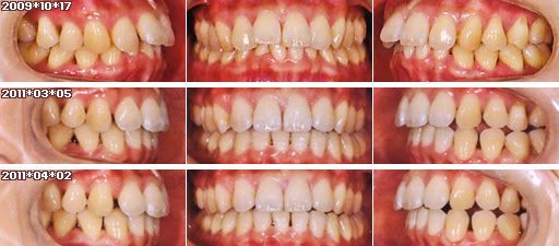 歯列矯正：定期検診その8