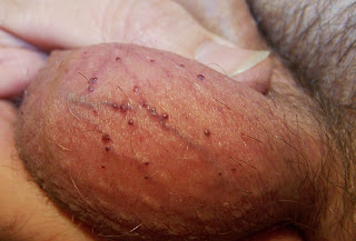 fordyce spots sebaceous prominence