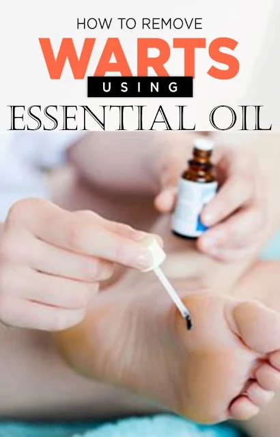 How To Remove Warts & Infection Using Essential Oil