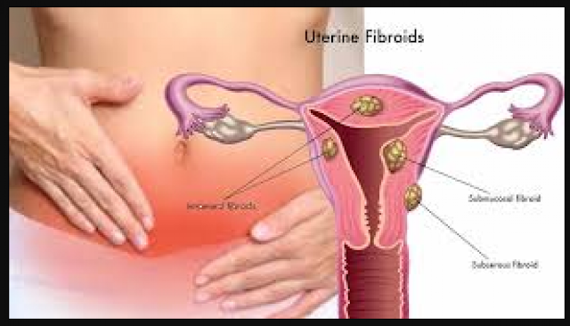 UTERINE FIBROID? CAUSES, SYMPTOMS, WHICH SIZE IS DANGEROUS? COMPLICATIONS, FIBROIDS PREGNANCY, TREATMENT