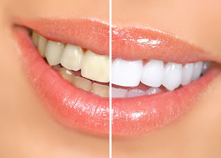 teeth whitening dentist