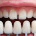 Bọc răng sứ 2 răng cửa thẩm mỹ