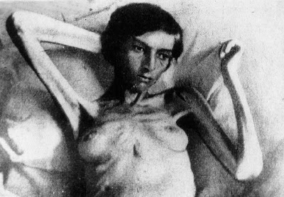 Starving woman who survived a Nazi death camp