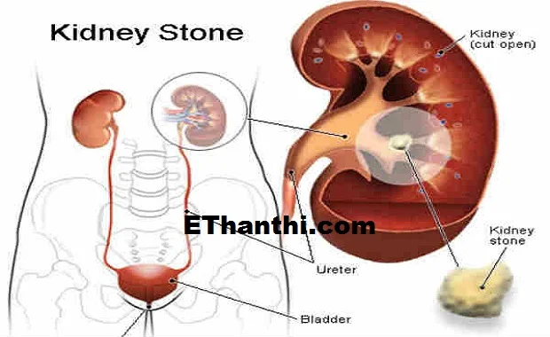 சிறுநீரக கற்களில் வகைகள்