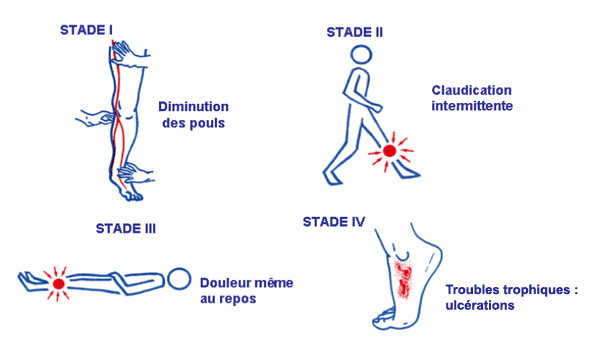 Récap' IDE: L'artérite ou artériopathie oblitérante des membres ...