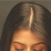 dandruff-causes-cure