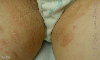 Tinea cruris, micose eritematosa na região inguinal