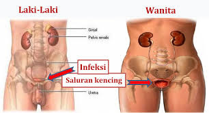 Pada Kemaluan Terasa Sakit dan Perih Keluar Nanah