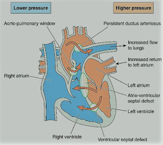 Eisenmenger’s Syndrome