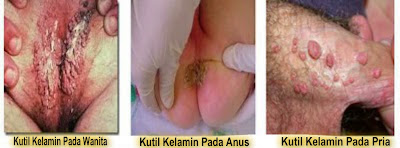 Kutil Kelamin