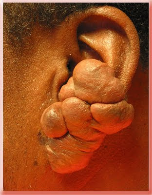 This patient had a keloid from an ear piercing removed with inadequate care 