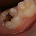 Phương pháp khắc phục răng sâu lỗ to nên biết