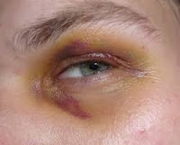How to Treat Eye Bruising