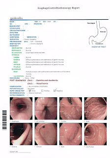   hernia คือ, โรคไส้เลื่อนในผู้หญิง, ไส้เลื่อน อาการ วิธี-รักษา, ไส้เลื่อนลงอัณฑะ อาการ, สมุนไพรรักษาโรคไส้เลื่อน, วิธี รักษา โรค ไส้เลื่อน, ไส้เลื่อน ภาษาอังกฤษ, โรคไส้เลื่อน ภาษาอังกฤษ, ไส้เลื่อนสะดือ ผู้ใหญ่