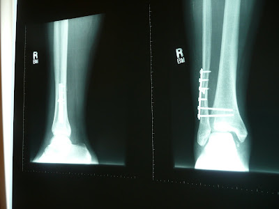 This is the broken leg x-ray.