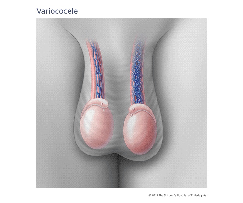 Varicocele - É possível engravidar com varicocele?