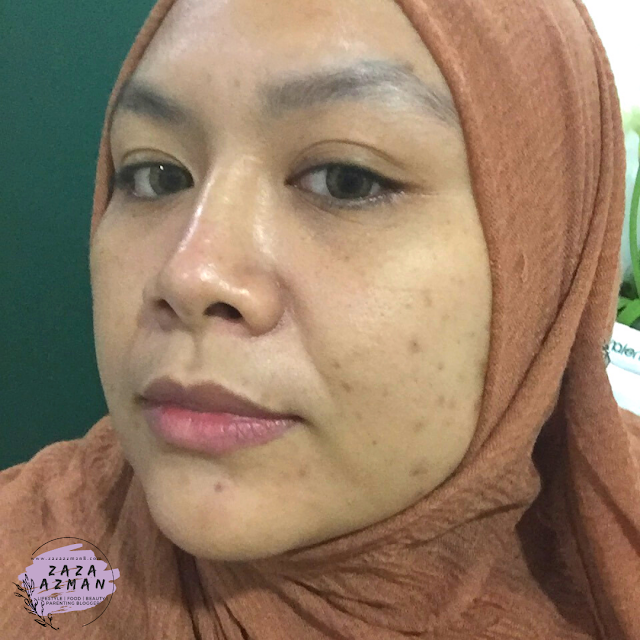 Dermalene Chemical Peel Pigmentation Treatment