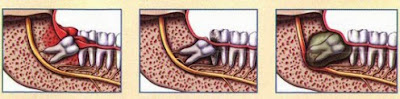 Cách nhổ răng khôn hiệu quả không gây viêm nhiễm