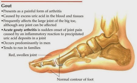 Set Gout Shaklee Sebagai Alternatif Rawatan Untuk Gout