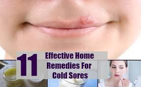 Effective Cold Sore Natural Remedies