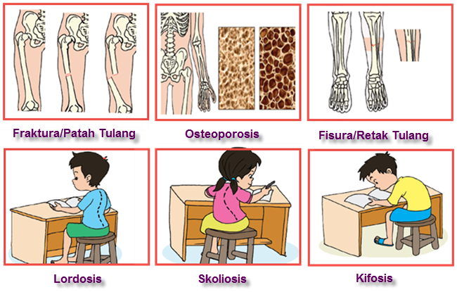 Macam macam Kelainan  pada Organ  Gerak  Pasif Tulang 