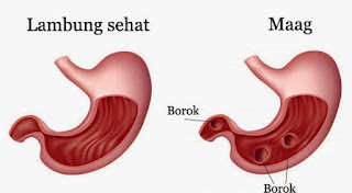 Ciri-Ciri, Penyebab, dan Obat Alami Sakit Maag