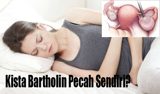 kista bartholin pecah sendiri