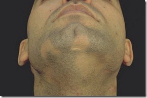 alopecia
