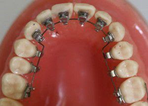 Các loại niềng răng thẩm mỹ hiện nay 3