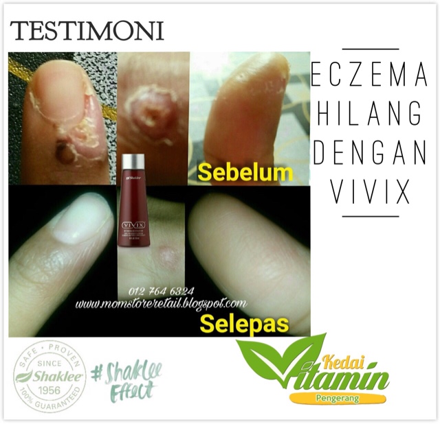 Ubat Eczema Orang Dewasa - Rawatan m