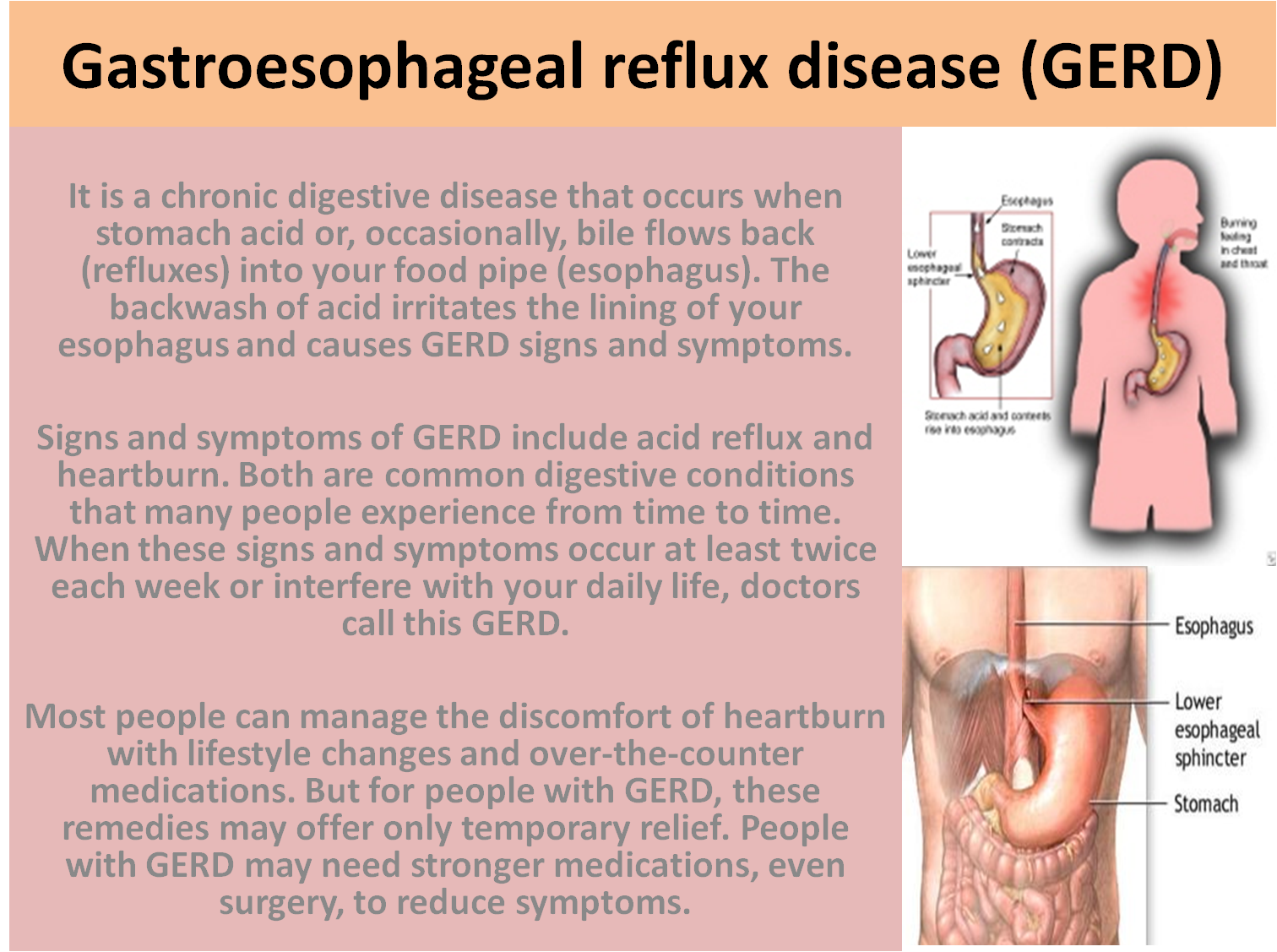 muscles especially Gastroesophageal reflux disease or acid reflux
